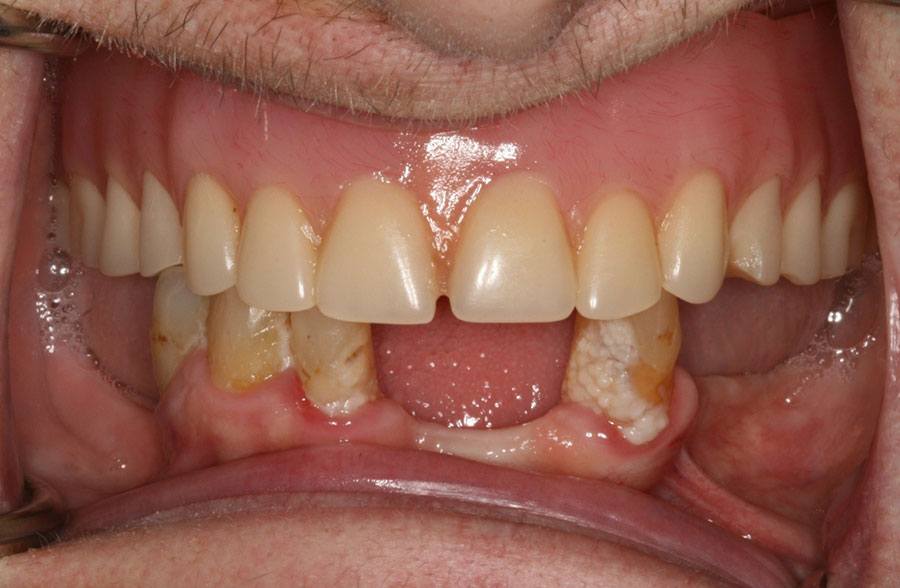 All on 4 Dental Implant Fixed Bridge | Dentist in Meriden, CT All on 4 Dental Implant Fixed Bridge | Dentist in Meriden, CT